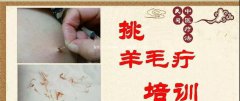 3月16日「山东·德州」李红民间技法“挑羊毛疔”“刺血拔罐”