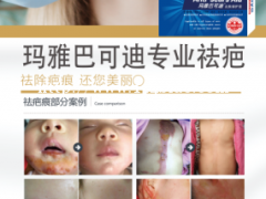 抑制疤痕增生达到真实祛疤——玛雅巴可迪