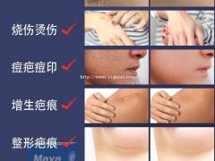 赛生玛雅巴可迪分享：决定疤痕修复时间长短的因素