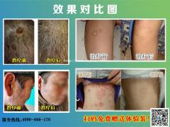 老人身上得了牛皮癣_可以用适今可吗？
