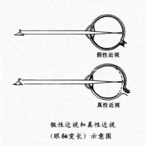 假性近视怎么办？