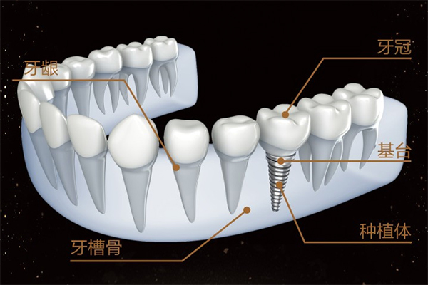 合肥种植牙一颗价格_集采后的价格很便宜！